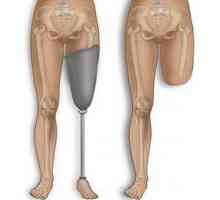 Ампутация на крака: рехабилитация на възможните последствия