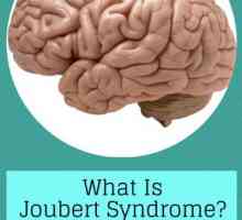 Болест на нивото на генетиката - синдром на Joubert