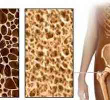Плътността на костното вещество и остеопороза - още един шанс, за да разберете предварително за…