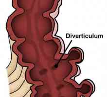 Дивертикулит на дебелото черво: симптоми и лечение
