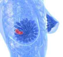 Фиброциститно заболяване на гърдата: лечение, симптоми и причини за