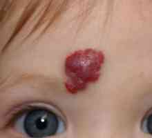 Хемангиоми на лицето: причини и лечение. Хемангиоми по лицето на възрастни и деца