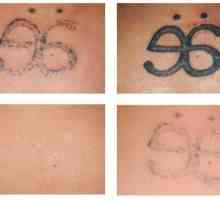 Да се ​​отървем от грешките на миналото: Лазерно премахване на татуировки