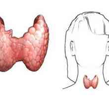 Какви са симптомите на заболяване на щитовидната жлеза за жени