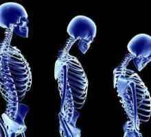 Какво лекар лекува остеопорозата? Остеопорозата: Симптоми, причини, лечение и профилактика