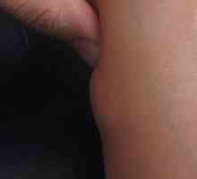 Липом (мастна тумор) на краката си: причини, симптоми и лечение