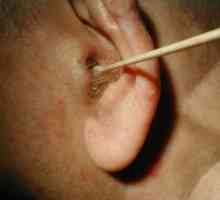 Отит на външното ухо: симптоми и лечението