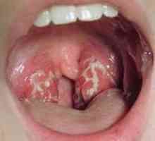 Къде ауреус в гърлото. симптоми на инфекция