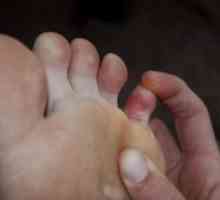 Фрактура на малкия пръст на крака си: Първа помощ