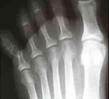 Фрактурите на пръстите на краката: причини, симптоми и лечение