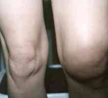 Защо коляното е подуто и възпалено? Причини и лечение