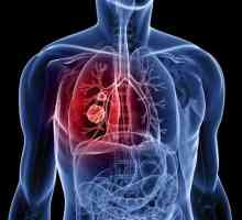 Плоскоклетъчен рак на белия дроб: описание, причините, диагностиката и лечението функции