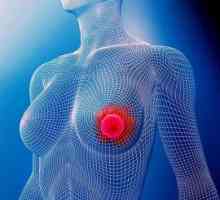 Рак малочнай залозы, 2а стадыя: прагноз. Рак грудзей 2а стадыі лечыцца?
