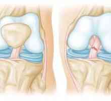 Разрушаването на сухожилията на коляното