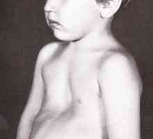 Детето има гръдна уродливост: Причини за патология и лечебни методи