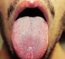 Разберете какво е причината за бели петна по езика при възрастни