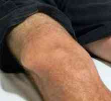 Разместване на колянната става: основните симптоми, лечение