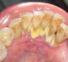 Зубной камень. Выдаленне і прафілактыка