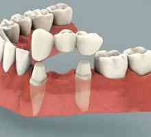 Зубной мост: водгукі. Ўстаноўка зубнога моста