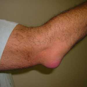 Бурсит - Лечение на бурсит. болест "бурсит". Лечение на рамото бурсит
