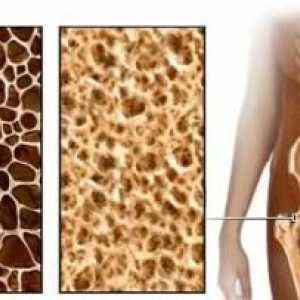 Плътността на костното вещество и остеопороза - още един шанс, за да разберете предварително за…