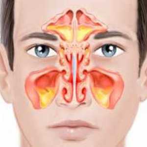 Двустранни синузит: симптоми и лечение