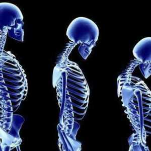 Какво лекар лекува остеопорозата? Остеопорозата: Симптоми, причини, лечение и профилактика
