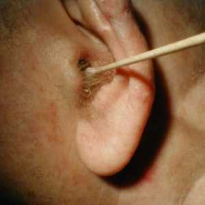 Отит на външното ухо: симптоми и лечението