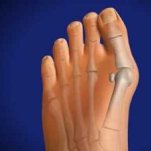 Отглеждане кост в крака: Причини, симптоми, лечение
