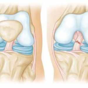 Разрушаването на сухожилията на коляното