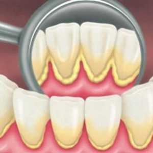 Выдаленне зубнога налёту: прафесійная чыстка зубоў