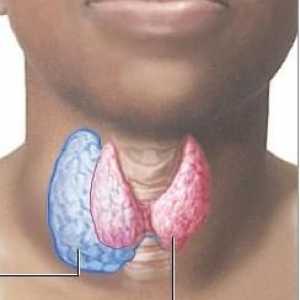 Нодуларна гуша на щитовидната жлеза: причини, симптоми и лечение