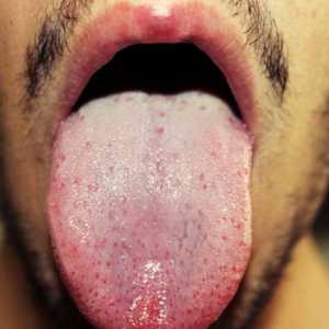 Разберете какво е причината за бели петна по езика при възрастни