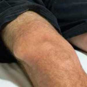 Разместване на колянната става: основните симптоми, лечение
